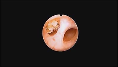 Interest of URS-L in the Treatment of Ureterolithiasis in Preschool Children
